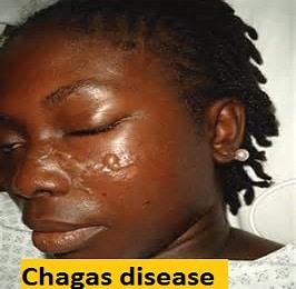 pests and diseases chagas-disease
